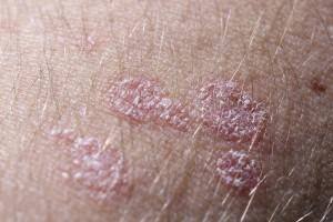 Seborrheic Dermatitis Types Causes Treatment Complications And