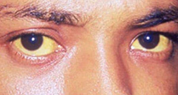 Yellow eyes