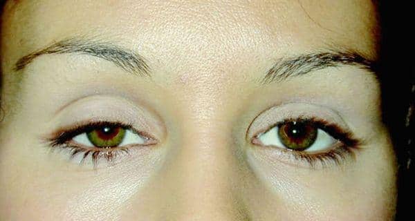 droopy-eyelids