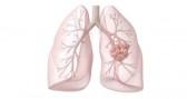 lung-cancer