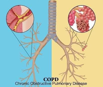 signs and symptoms of copd