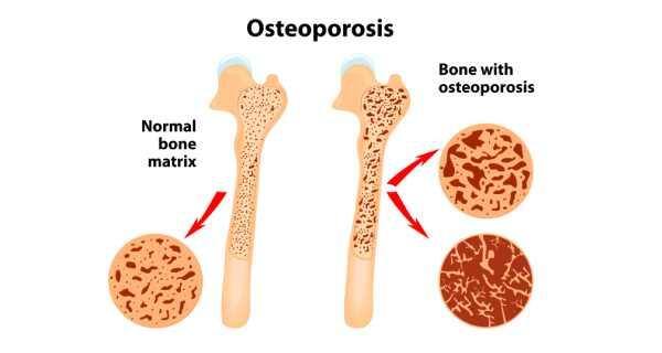 What is the main cause of osteoporosis?