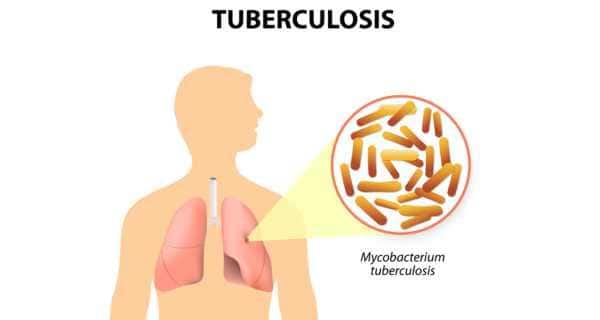 Sex Tuberculosis 94