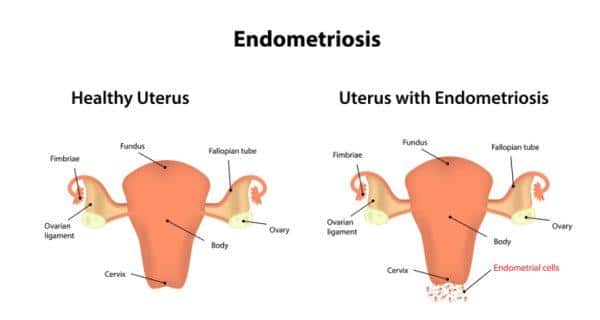 Ca 125 Marker Endometriosis Diet