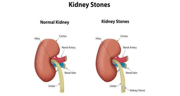 Where can you find a picture of a kidney stone?