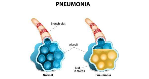 Hasil gambar untuk pneumonia