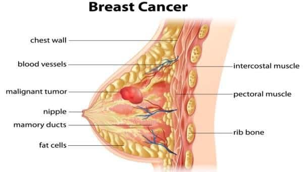 Image result for photo of breast cancer