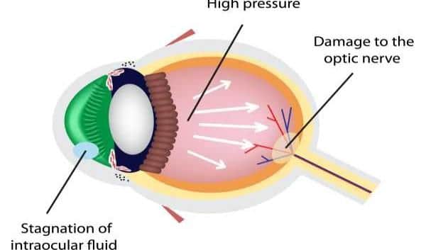 What is considered normal eye pressure?