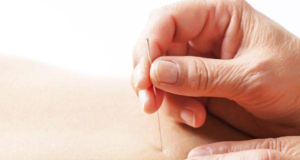 acupuncture