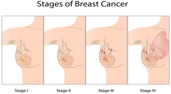 What are causes of breast cancer?