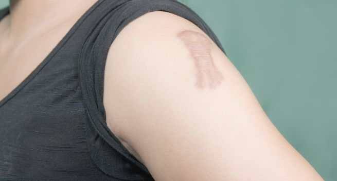 Keeping the area dry will heal the scar