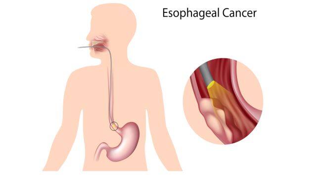 Esophageal cancer