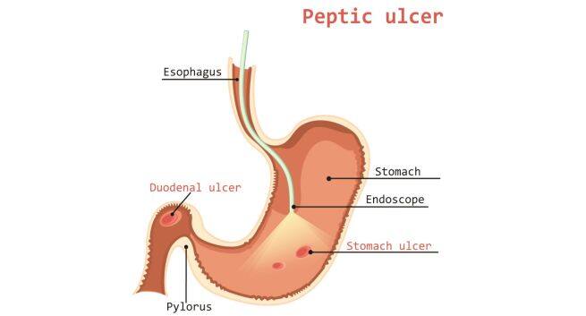 Peptic ulcer