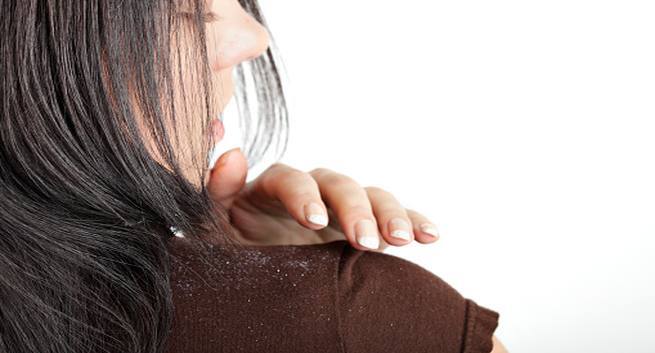 Side effects of dandruff