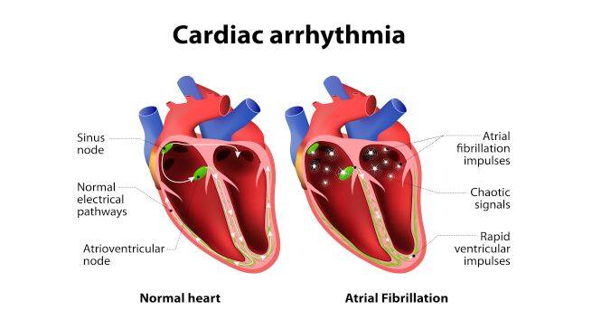 Cardiac arrhythmia