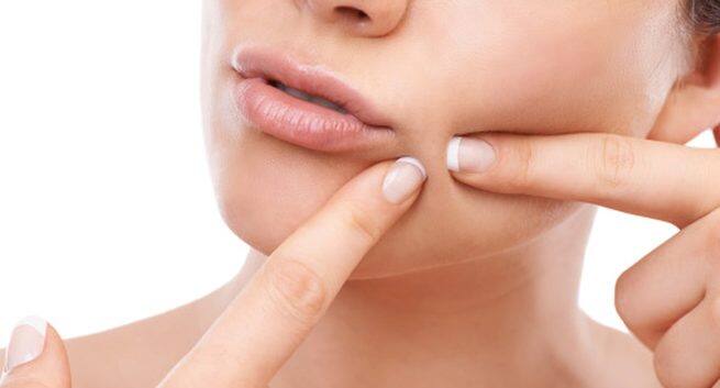 Home remedies for acne that don't work