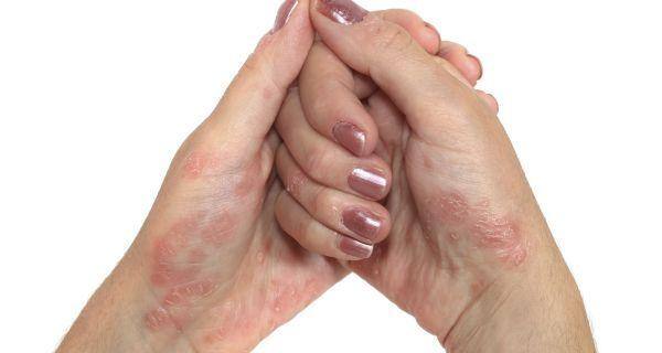 Oral and therapy treatment for psoriasis Oral and therapy treatment for psoriasis