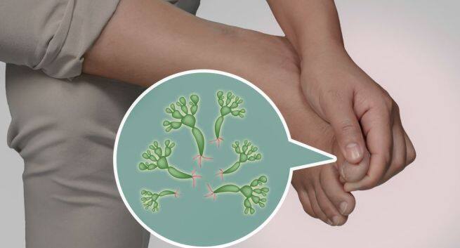 Fungal skin infections
