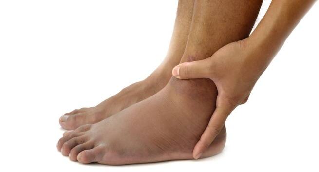 Swollen-fet