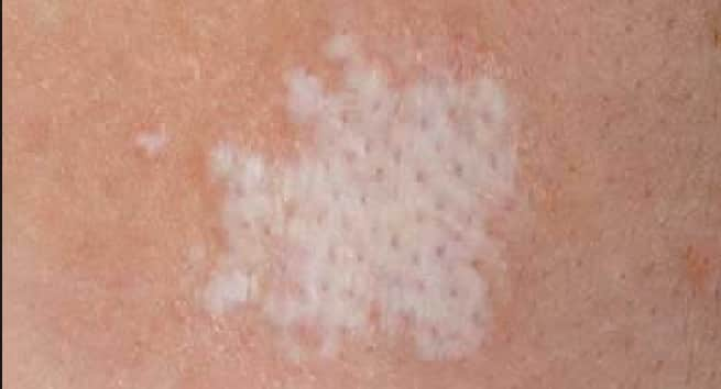 What are common causes for spots on the skin?