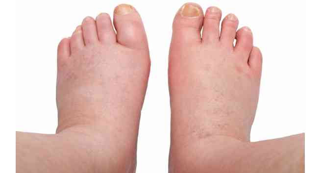 water retention