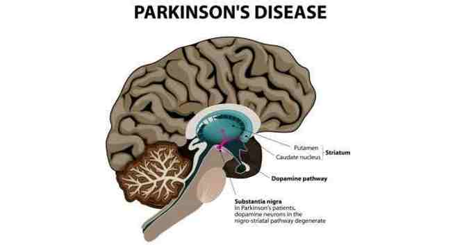 Parkinsons-disease