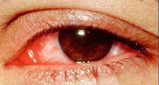 Red-eyes