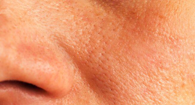 10 home remedies for reducing the size of large pores on your face