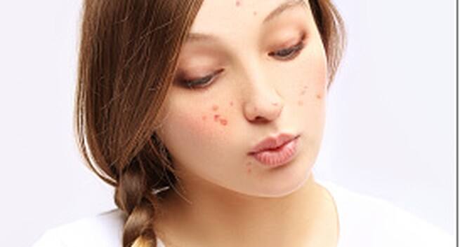 Rosacea Hindi