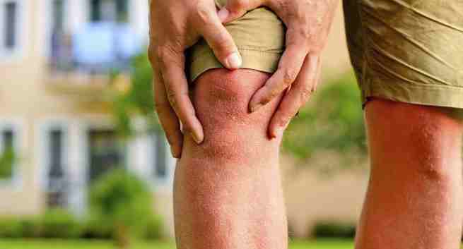 arthritis