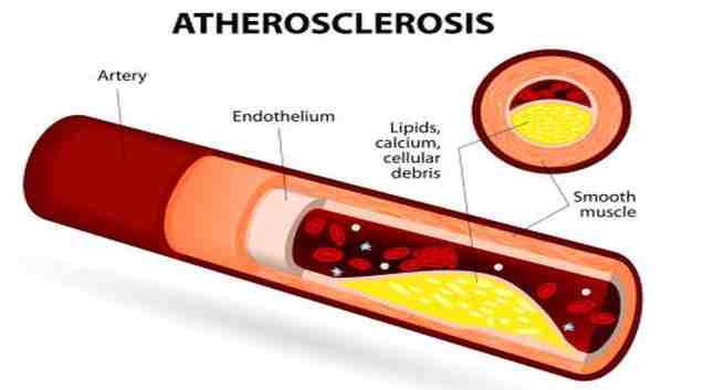 atherosclerosis