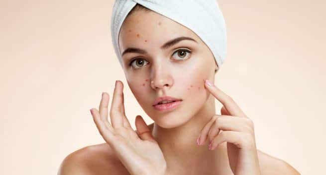 acne Hindi