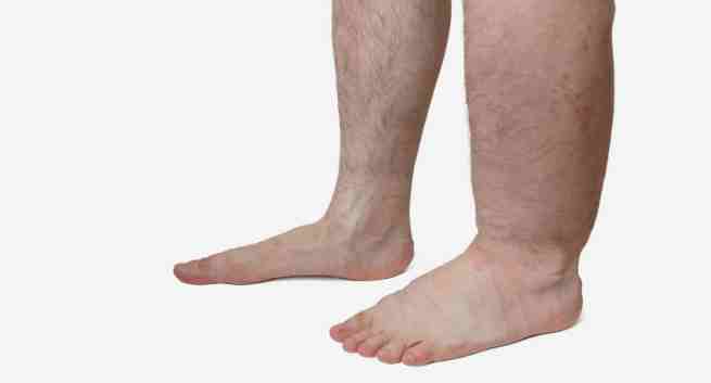 Foot skin conditions | DermNet New Zealand