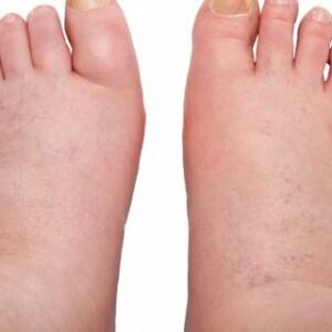 A new treatment could fast-track elephantiasis elimination A new treatment could fast-track elephantiasis elimination