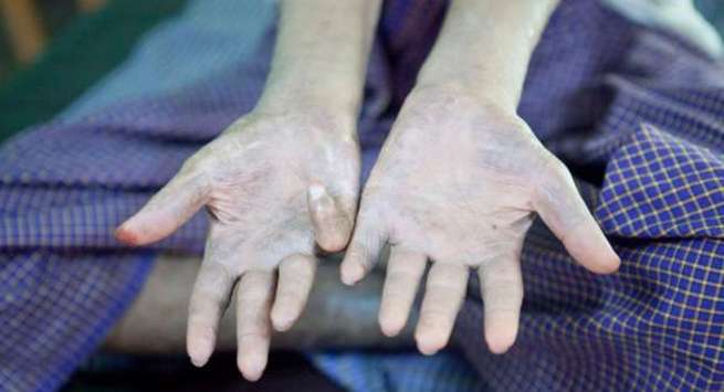 Leprosy