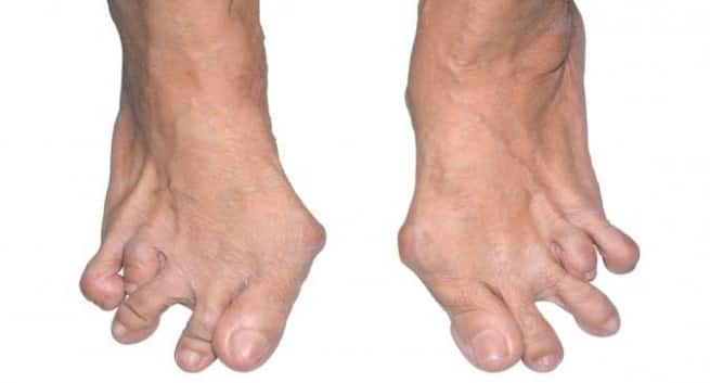 How rheumatoid arthritis affects the foot and ankle Read Health Related
Blogs, Articles \u0026 News