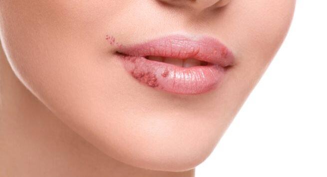 Herpes
