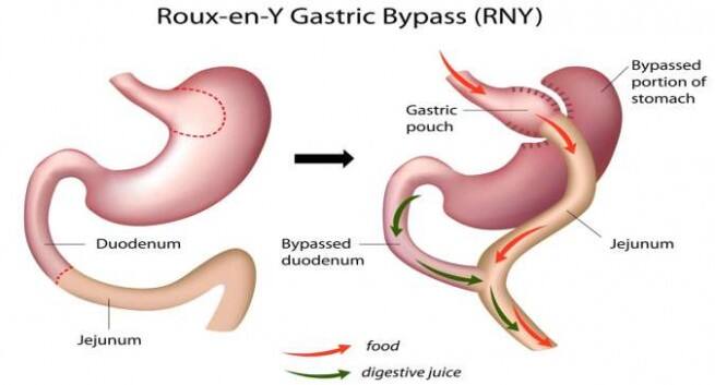3 Types Of Bariatric Surgery You Need To Know About