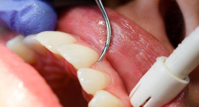 Bleeding gums