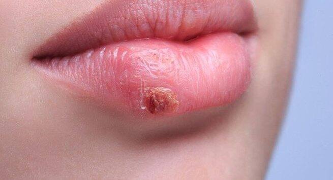 Sore vagina sore skin sore throat