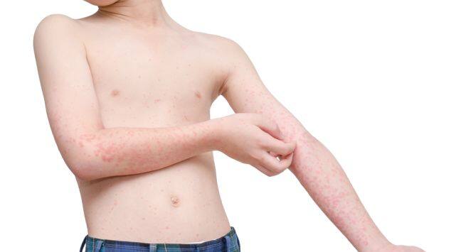 chicken pox mistakes Hindi