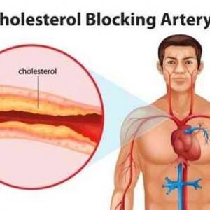 Can a lean person have a heart attack? (query) Can a lean person have a heart attack? (query)