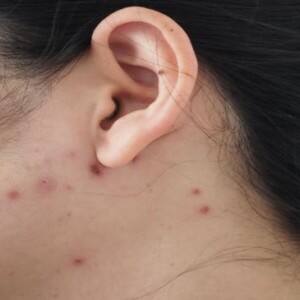 9 ways to keep your family healthy when someone suffers from chickenpox or other infectious conditions 9 ways to keep your family healthy when someone suffers from chickenpox or other infectious conditions