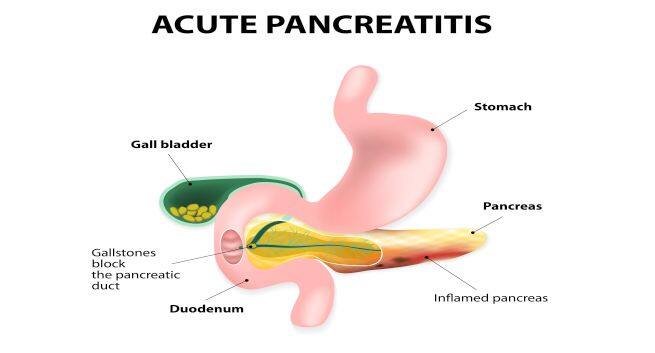 Acute-Pancreatitis Hindi