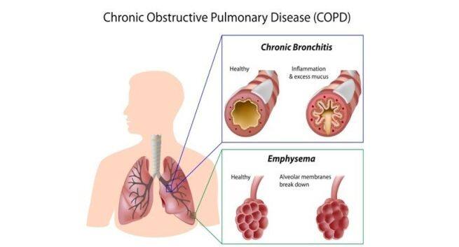 COPD Hindi