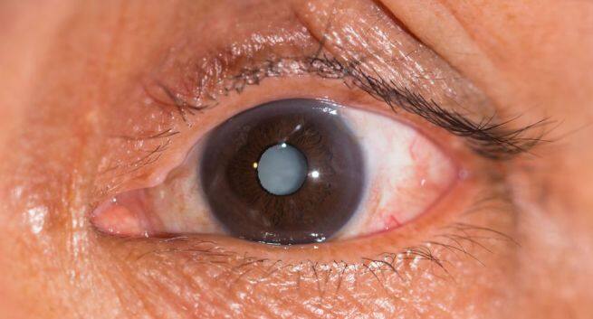 Cataract Hindi