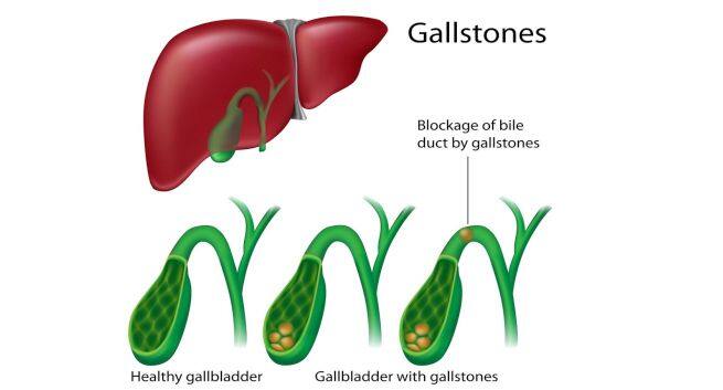 Gallstone-disease Hindi