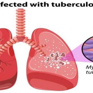 World TB Day 2017: Can tuberculosis be cured? World TB Day 2017: Can tuberculosis be cured?