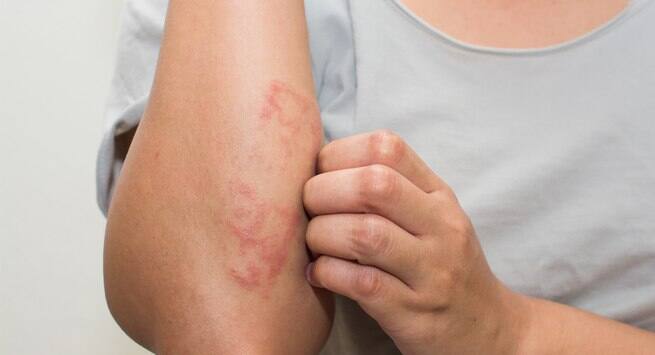 Eczema Hindi