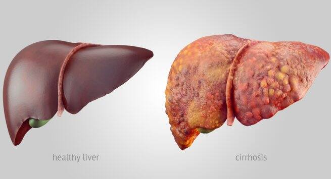 cirrhosis